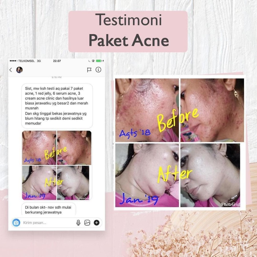 Ms Glow Paket Acne Series Free Pouch / Cream Penghilang Jerawat