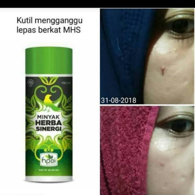 Minyak Herba Sinergi Hpai Hni Shopee Indonesia