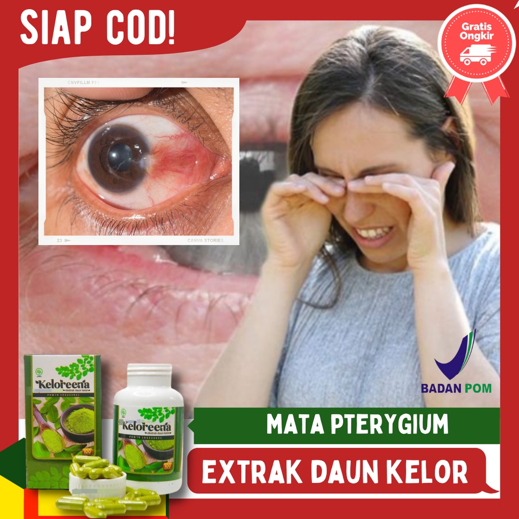 Cara mengatasi pterygium pada mata sebelah kiri/Kanan | Suplemen Mata, Obat Mata Ptergium, Mata Berl