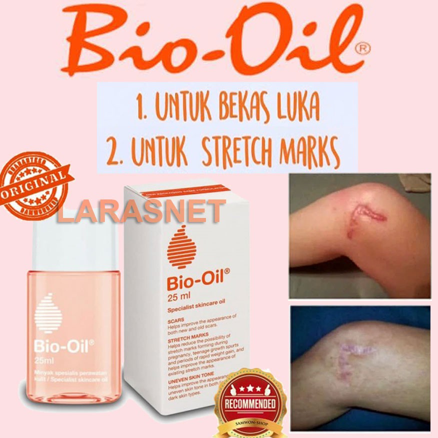 Original Obat Bio Oil Penghilang Scar Strechmark Cream Bekas Luka Kulit Knalpot Bakar Seluit Goresan Shopee Indonesia