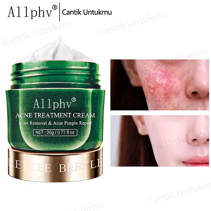 [Ori100%] Allphv Acne Treatment Cream Penghilang Jerawat Anti Acne Pimple Removal Spots Oil Control Shrink Pores Moisturizing Face Krim 20g Perawatan &amp; Kecantikan