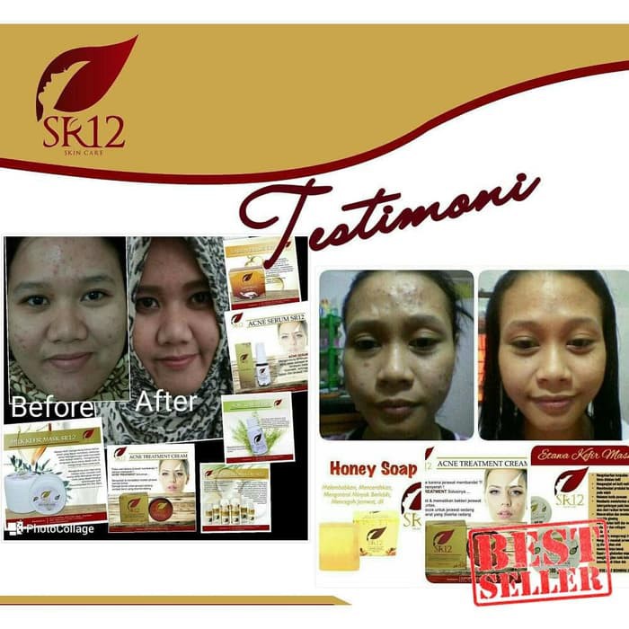 Sr12 Acne Treatment Cream - Perawatan Jerawat Untuk Muka Wajah - Sr12 Exclusive