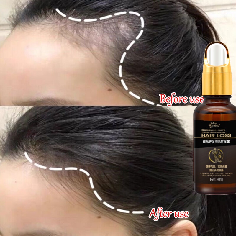Penumbuh rambut botak Serum rambut rontok 30ml Penumbuh rambut cepat Kontrol minyak Menyuburkan rambut Mencegah Kebotakan-2