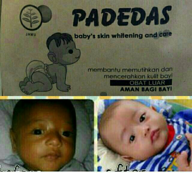 Obat pemutih kulit anak