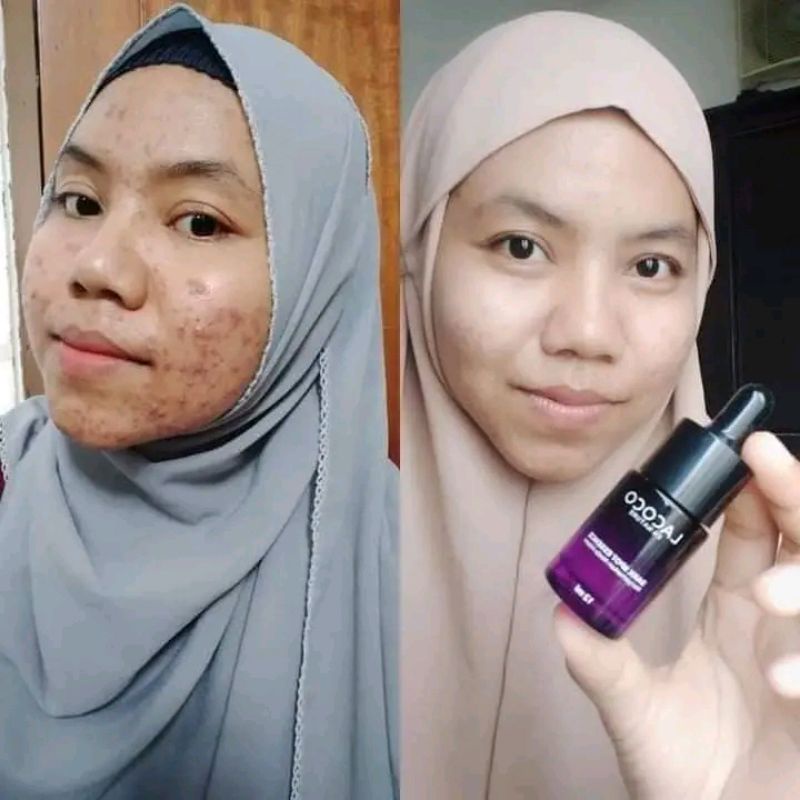 Lacoco dark spot - anti jerawat - anti bintik hitam