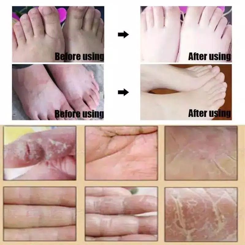 Obat kaki pecah pecah tangan tumit ampuh kering tebal mengelupas cream salep mulus 100%