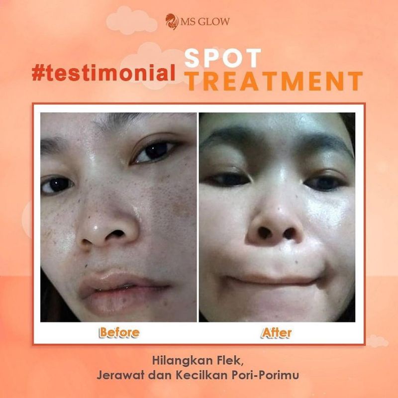 PROMO SPOT TREATMENT MSGLOW DARK SPOT PORE AWAY ACNE SPOT