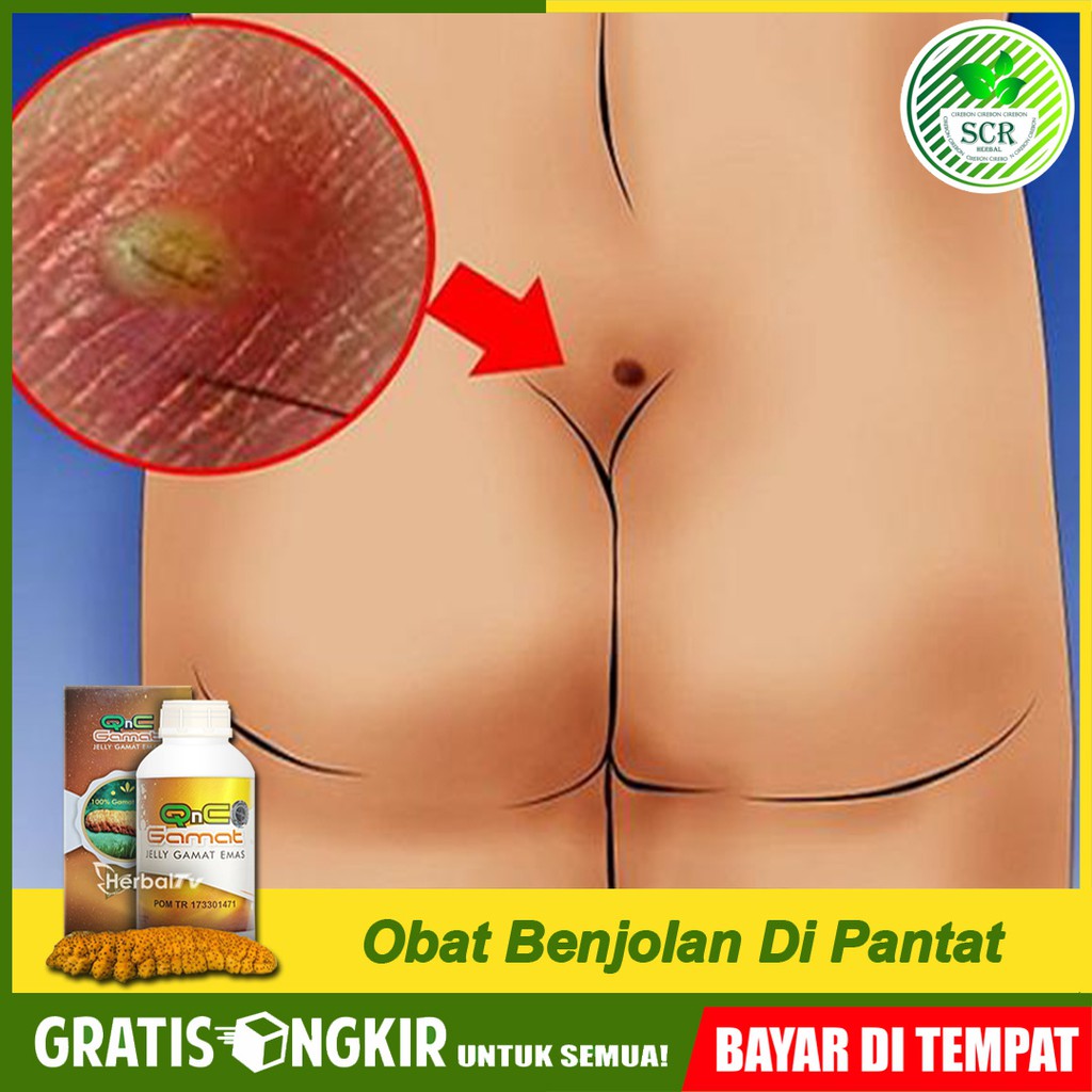 Obat Benjolan di Pantat Dubur Ambeyen Bisul Wasir Ambeien QNC JELLY GAMAT Di Cirebon