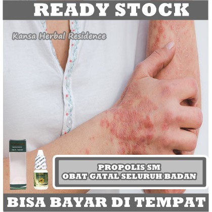 Obat Eksim Menahun, Eksim Kering, Salep Eksim, Eksim basah, Gatal Kulit Eksim, Eksim Parah, Eksim Kering Basah, Gatal Gatel Seluruh Badan, Kulit Kering Bersisik, Kurap, Panu, Psoriasis, Koreng, Jamur Kulit Selangkangan