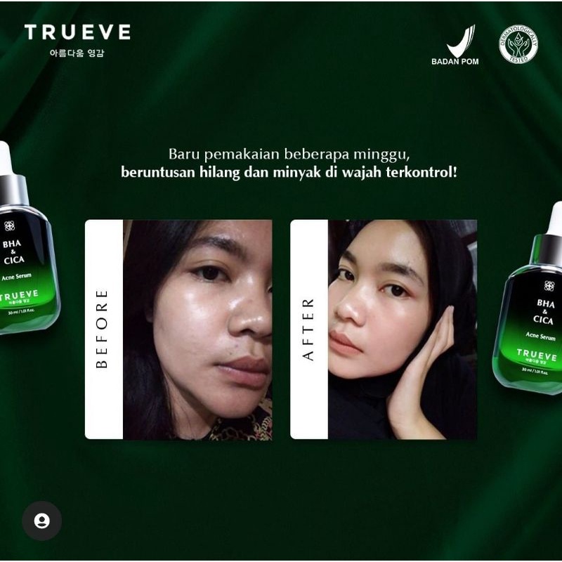 TRUEVE Acne Care Treatment Serum / BHA CICA 30 ML