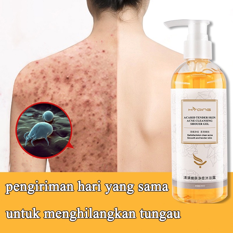 Acne Body Wash 260ml Whitening Body Wash sabun mandi jerawat Pembersihan Mendalam Menghilangkan tungau dan mengontrol minyak, mengecilkan pori-pori  memutihkan dan meremajakan kulit