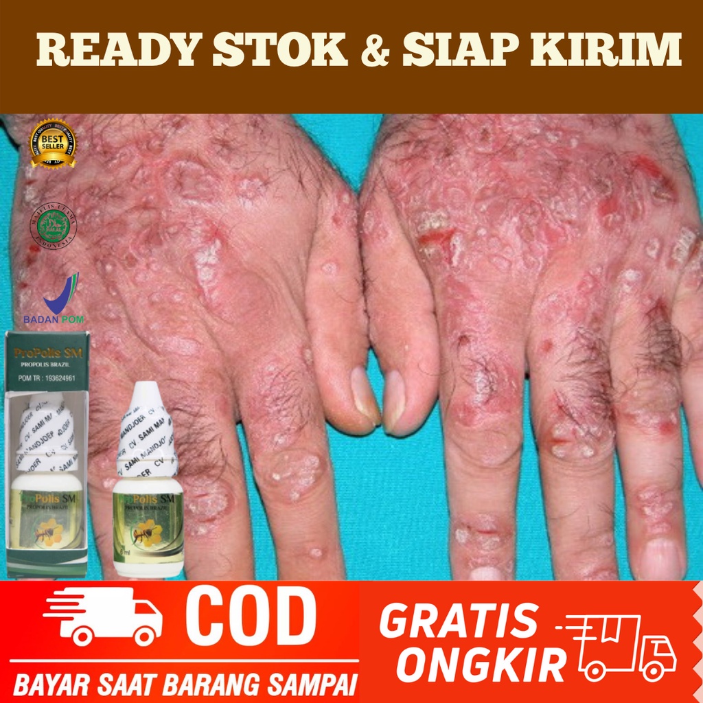 PROPOLIS SM 100% BPOM, Obat Borok Budug Bernanah, Obat Budug Dan Gatal, Buduk / Budukan, Obat Budug 