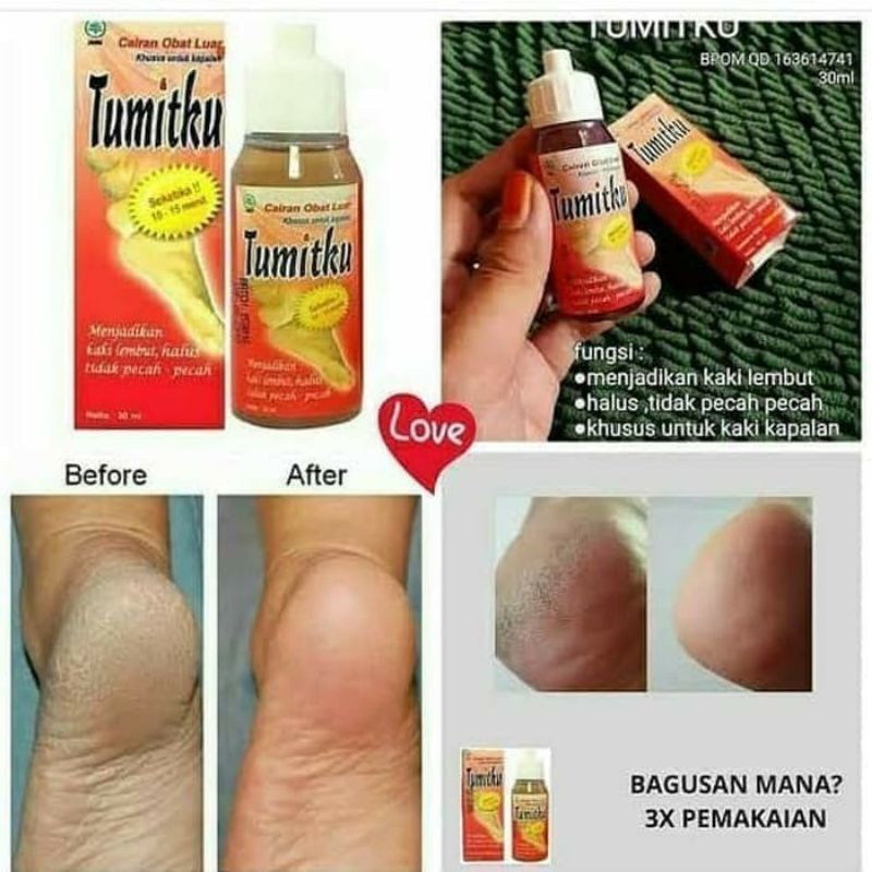 TUMITKU untuk kaki pecah pecah produk BPOM