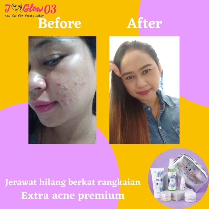 JGLOW SKINCARE EXTRA ACNE SULFUR UNTUK WAJAH BERJERAWAT