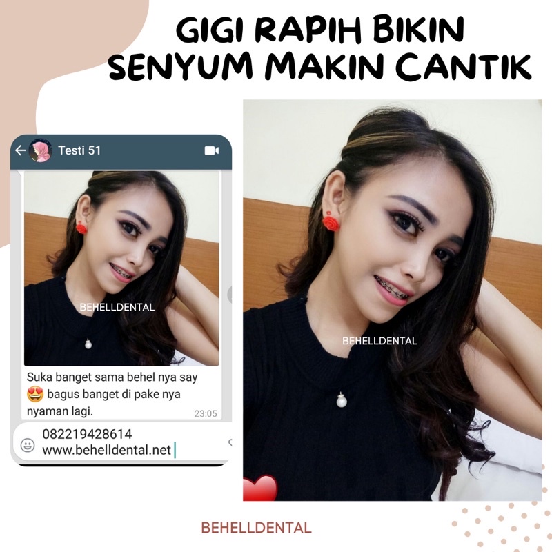 PAKET BEHEL PERMANEN METAL ORTHO BRACKET ORTHO CLASSIC USA ROTH WITH HOOK - Braces Dental OC OrthoClassic Untuk Perbaikan / Perawatan Gigi - Kawat Orthodontic Metalic - Behelldental Mim