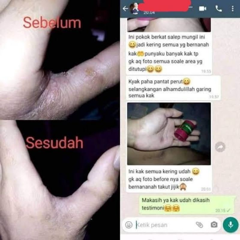 Cream Salep BL Murni Versi Original100% Tanpa Oplosan Salep Gatal Kutu Air Eksim Panu Kurap Ampuh