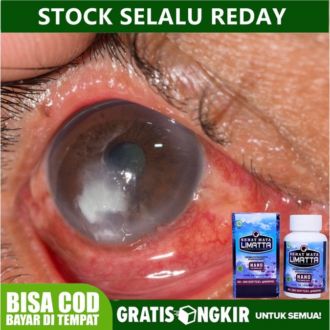 Obat Peradangan Pada Mata, Luka Pada Kornea Mata, Obat Ulkus Konera Mata - Limatta Sehat Mata