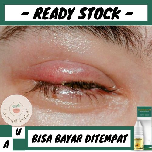 Obat Kalazion Parah, Obat Penghilang Kalazion, Obat Oles Pengempis Kalazion, Obat Herbal Propolis SM