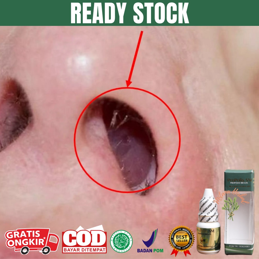 Harga Obat Luka Dalam Hidung Terbaru November 2021 Biggo Indonesia