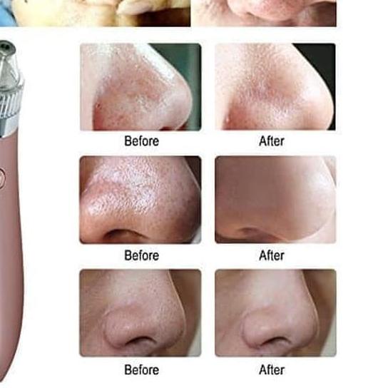 ➤ ALAT PENYEDOT KOMEDO DAN JERAWAT BEAUTY SKIN CARE CW - 666 ➲