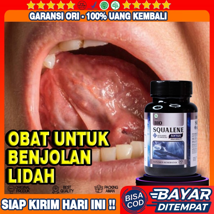 Obat Penghancur Benjolan Di Lidah - Mengempeskan Lidah Bengkak Dan Sariawan - Obat Penghilang Benjol