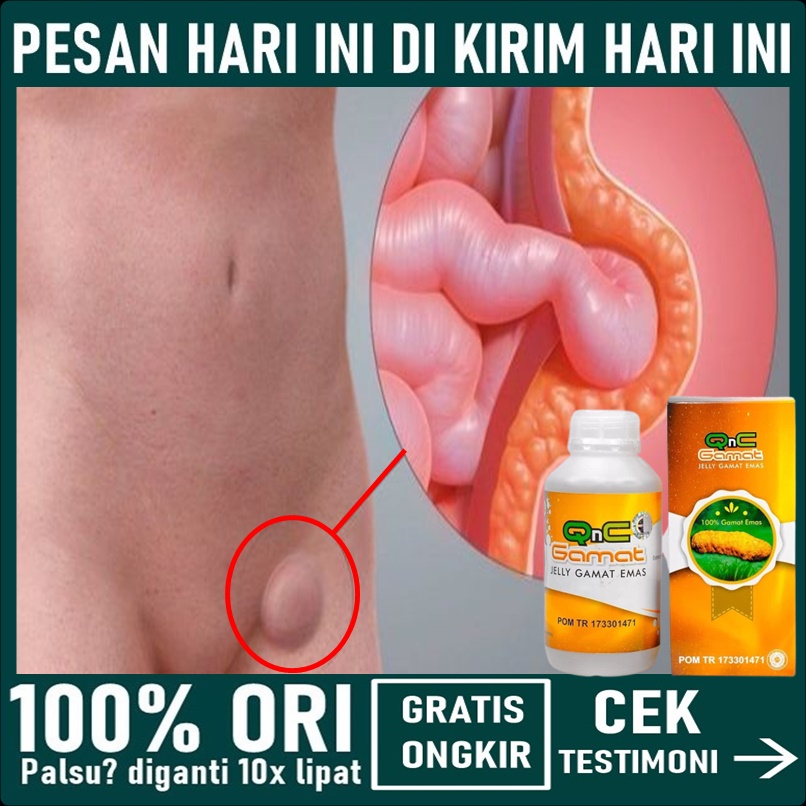 Obat Hernia Turun Berok Dewasa - Obat hernia Herbal - Obat Hernia Original - Obat Turun Berok Dewasa