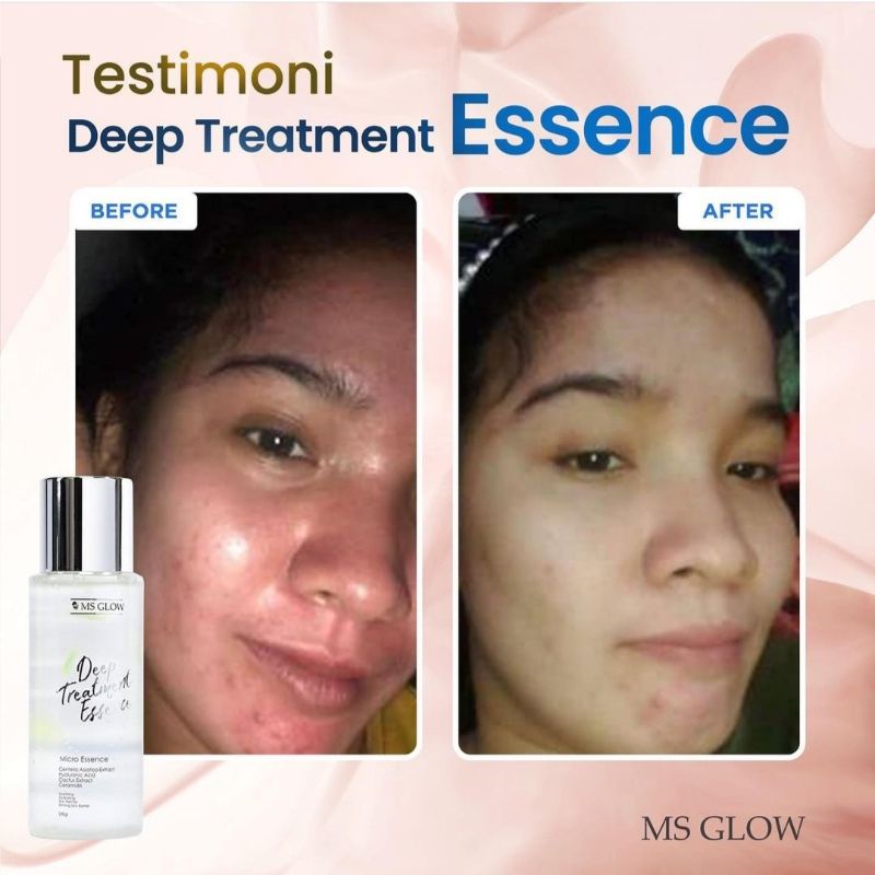 (Original 100%) Ms Glow Deep Treatment Essence / Deep Treatment Essence Ms Glow