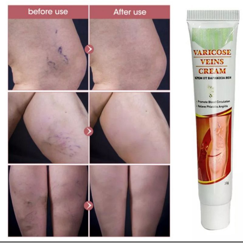 KRIM VARICOSE VEINS OBAT VARISES OBAT VARIKOKEL SALEP VARISES - VARICOSE