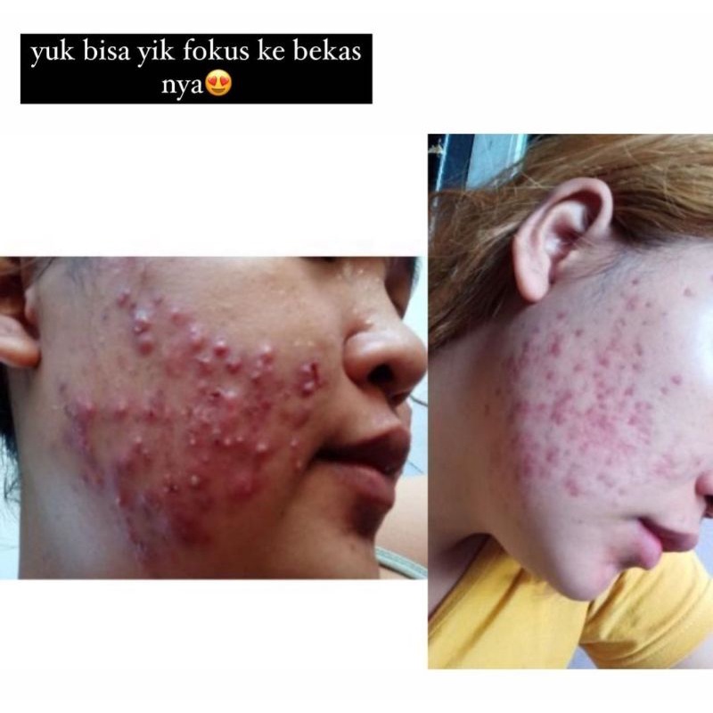Daviena skincare medan - Acne series Komplit / Paket Hemat Acne 1-2 Best seller-3