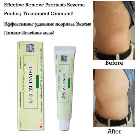 Zudaifu Salep Gatal Gatel Alergi Kulit Eksim Kurap Jamur Original-1