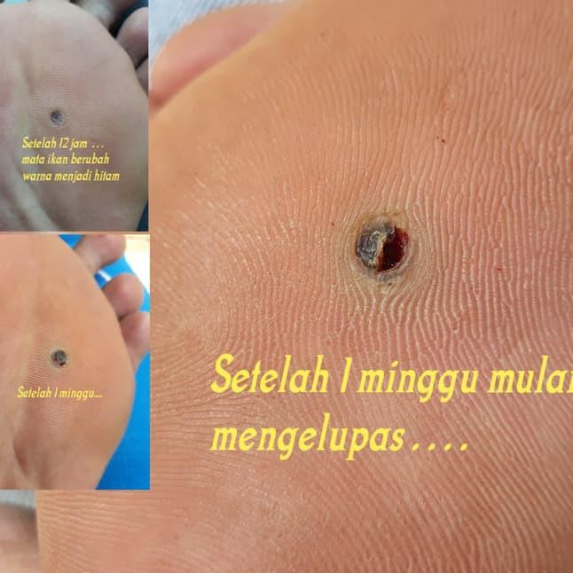 Segera Order  penyakit mata ikan atau clavus bukan plester  callusol Ewako
