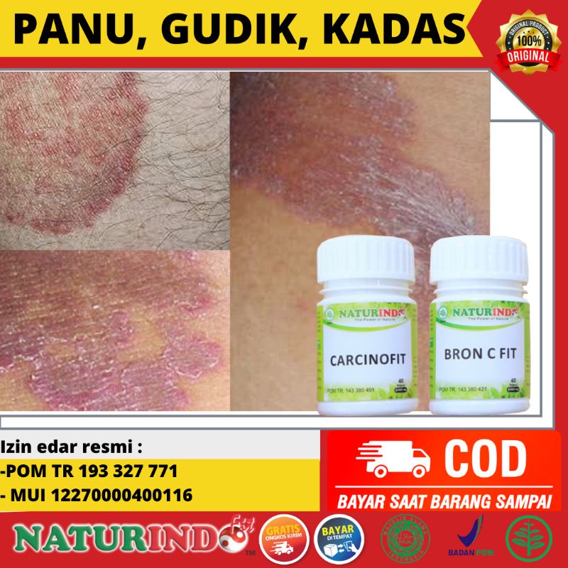 Obat Panu Herbal Ampuh Kadas Kudis Kurap Gatal Kulit Sensitif Gudik paling Ampuh