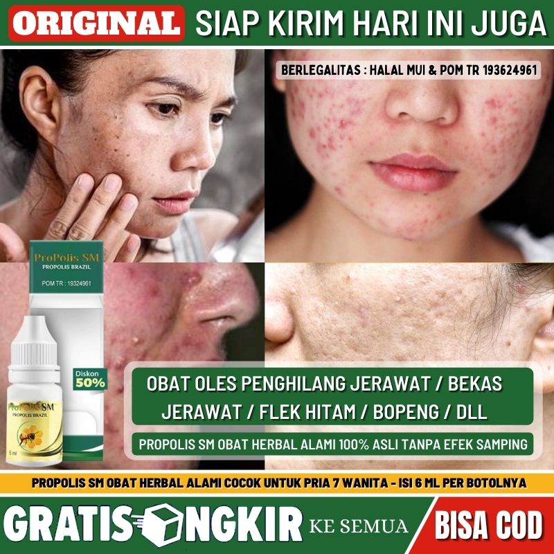 Obat Tetes Alami Jerawat Meradang Untuk Pria & Wanita, Obat Jerawat Batu, Penghilang Bekas Jerawat, 