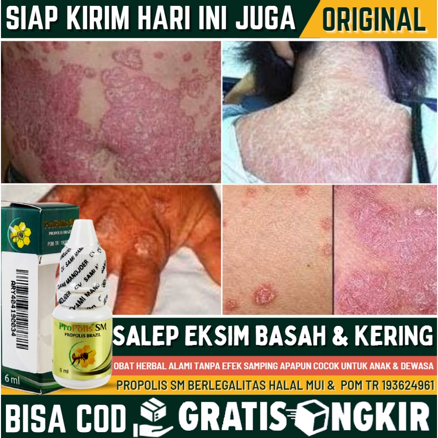 Obat Oles Penghilang Eksim di Selangkangan Pantat  Kemaluan - Obat Gatal Eksim di Kaki & Tangan, Sal