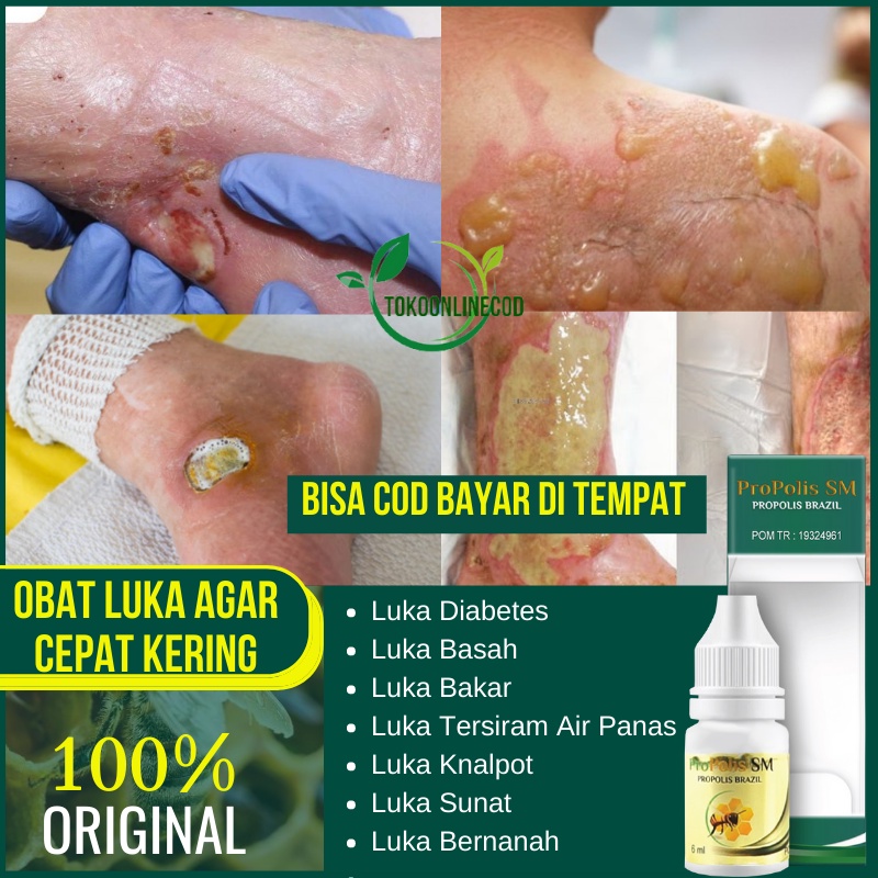 Obat Luka Agar cepat Kering, Pengering Luka Basah, Luka Diabetes, Luka Bernanah, Salep Luka Bakar Pa