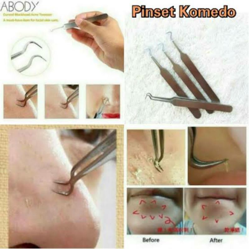 PINSET PENJEPIT PENCABUT KOMEDO JERAWAT / BLACKHEAD ACNE TWEEZER