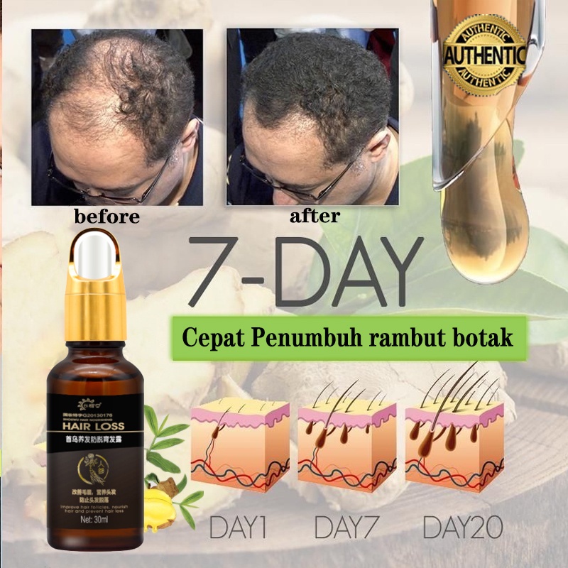 Penumbuh rambut botak Serum rambut rontok 30ml Penumbuh rambut cepat Kontrol minyak Menyuburkan rambut Mencegah Kebotakan-4