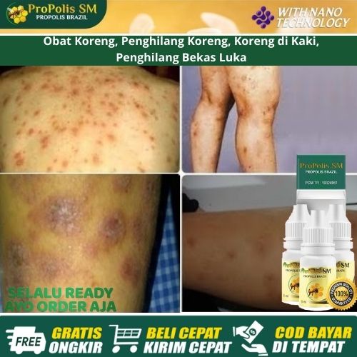 Obat Koreng, Penghilang Koreng, Koreng di Kaki, Kepala, Penghilang Bekas Luka - Propolis SM Brazil