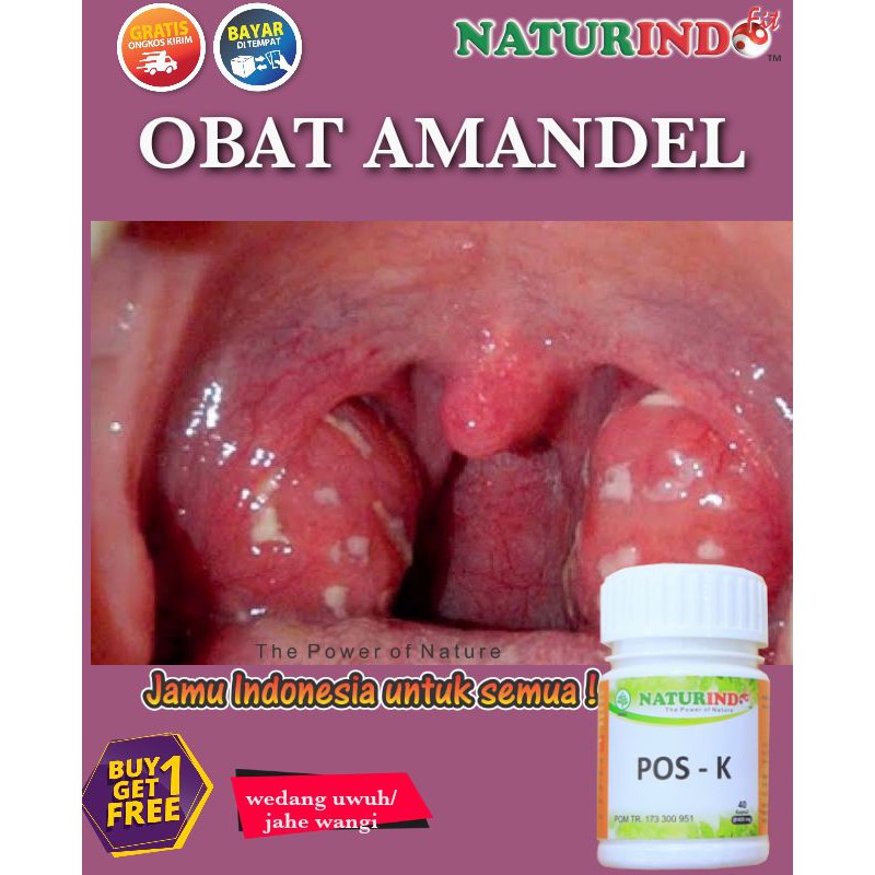 OBAT AMANDEL AMPUH-HERBAL AMANDEL TANPA OPERASI