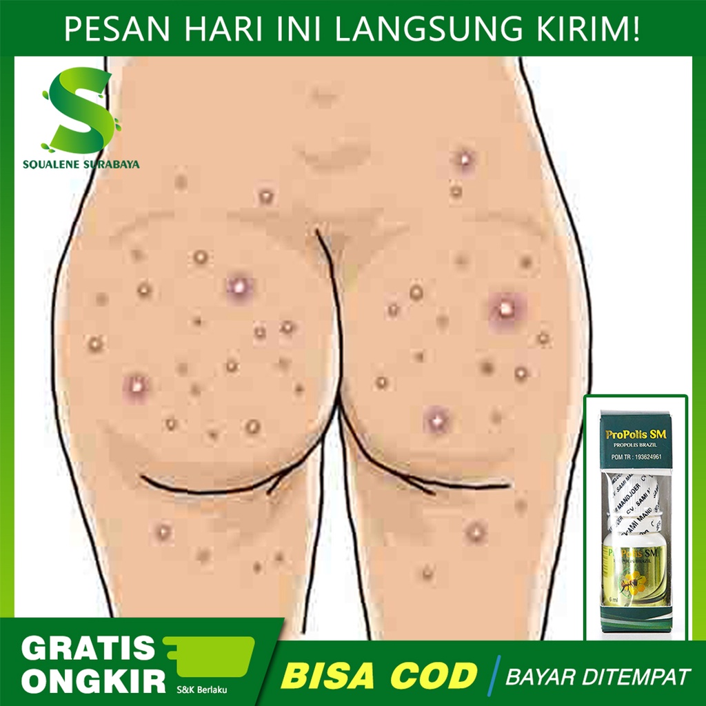 Obat Luka Hitam di Pantat, Penghilang Gatal, Budug Bernanah , PROPOLIS SM 100% ASLI