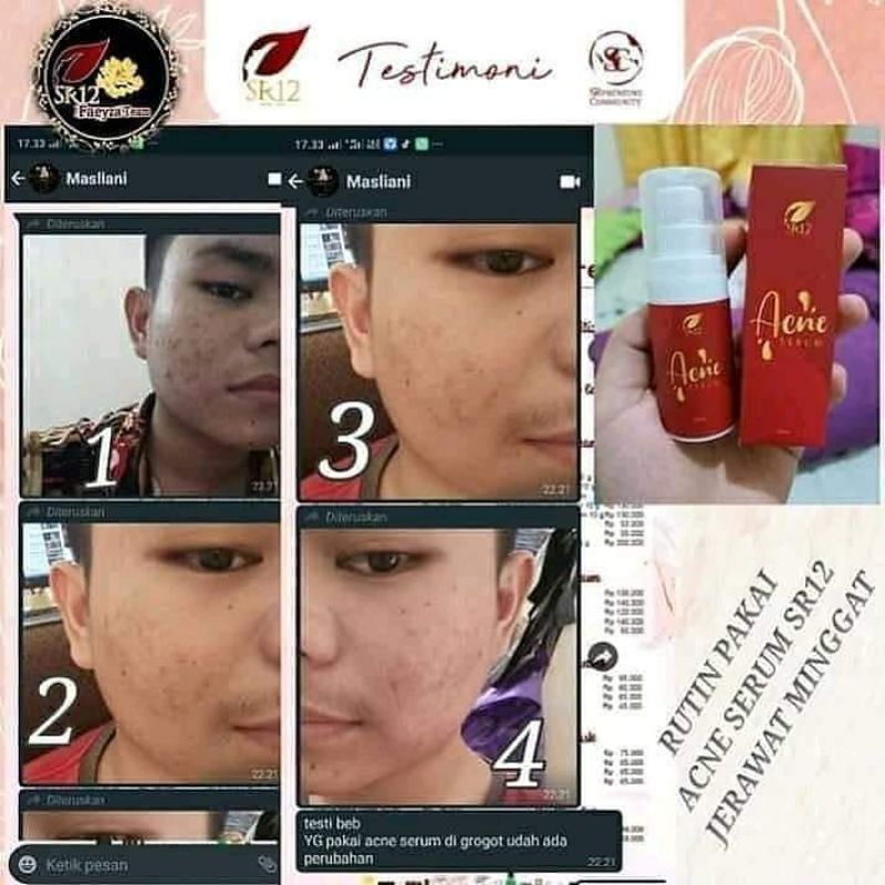 ACNE SERUM SR12 / MENYEMBUHKAN JERAWAT / BERUNTUSAN / MENGHILANGKAN BEKAS JERAWAT