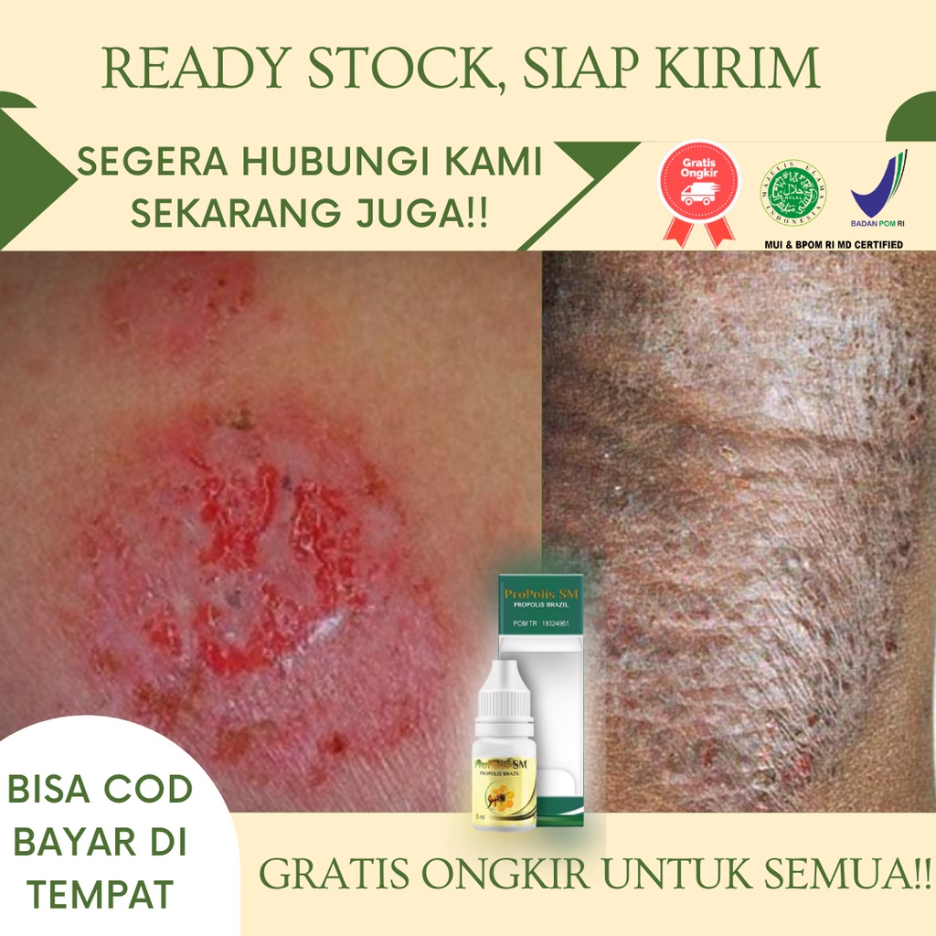 Obat Eksim Kering Menahun, Obat Eksim Basah, Obat Eksim Kering Menahun diKaki, Obat Gatal Eksim, Gat