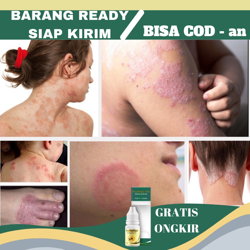Obat Gatal gatal Kulit, Obat Gatal gatal di Kaki, Obat Gatal gatal di Selangkangan, Obat Gatal gatal