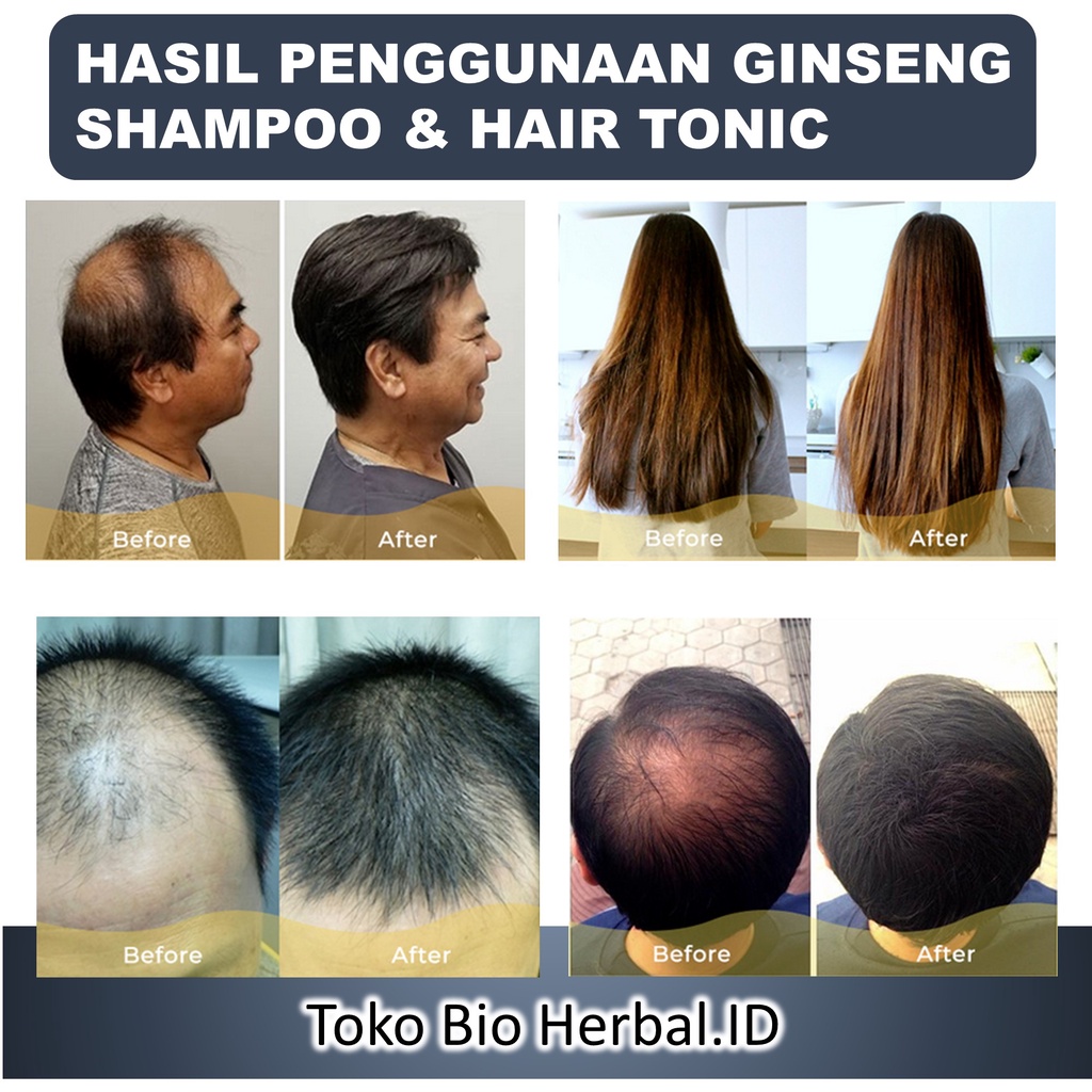 Shampo Anti Ketombe Shampoo Anti Ketombe Shampo Anti Dandruff Sampo Anti Ketombe Obat Ketombe B1R