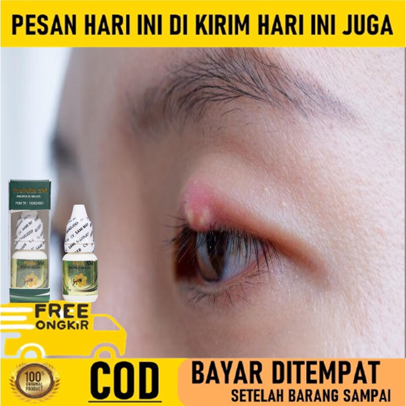 Obat penghilang benjolan kalazion - Obat kalazion di kelopak mata - Obat oles mata bintitan - Obat m