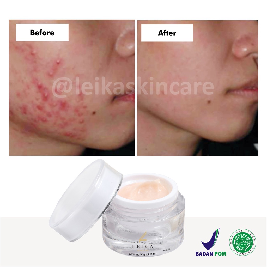 Asli! Penghilang Jerawat dan Bekas Jerawat Pria Wanita Paling Ampuh Permanen Penghilang Jerawat / Jerawat Pasir / Jerawat Batu / Bruntusan  - Leika Skincare Glowing Night Cream 100% Resmi BPOM Halal