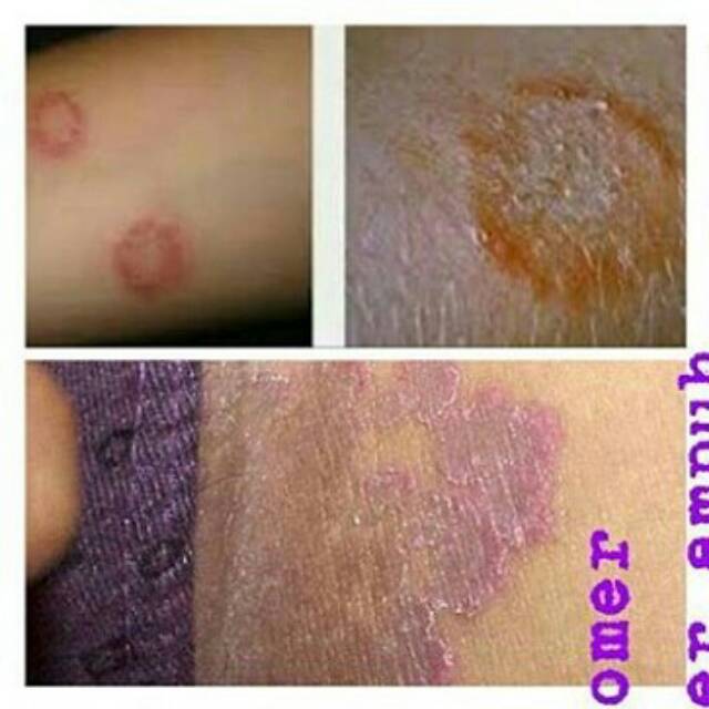 Obat Gatal Selangkangan Eksim Jamur Kadas Kurap Shopee Indonesia