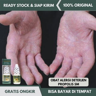 Jual Obat Alergi Deterjen, Obat Gatal Alergi Deterjen, Gatel Di Sela ...