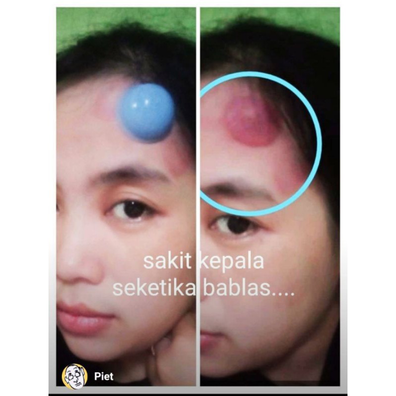 Kop Angin (bekam kering) KOP E ORIGINAL