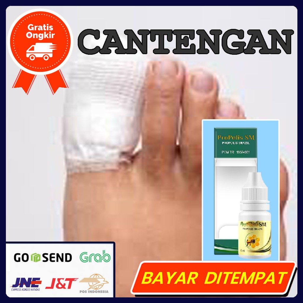 Obat Cantengan Kuku Tangan dan Kaki - Jamur Kuku (Bodo Isi)